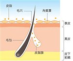 にきびの原因
